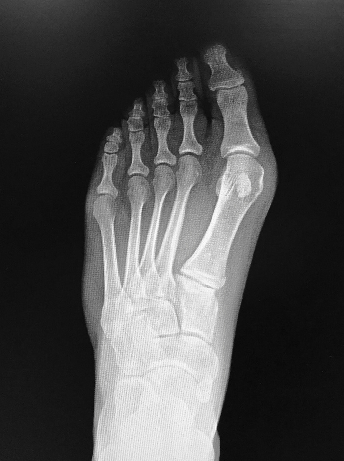 Xray Foot with Bunion